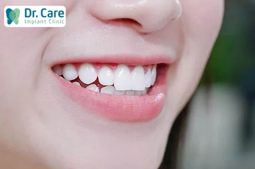 Sử dụng răng toàn sứ sẽ không bị nhiễm màu
