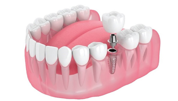 Trồng răng Implant răng hàm