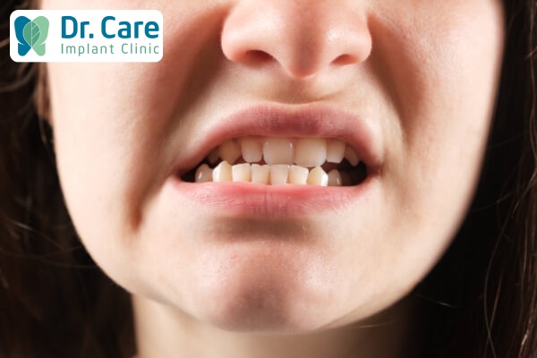 Răng bị sai lệch khớp cắn có thể khắc phục bằng phương pháp trồng Implant Pháp