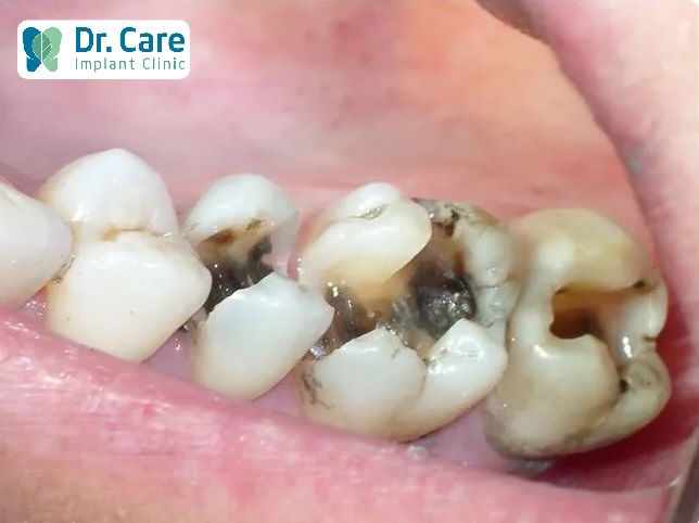 Sâu răng có thể dẫn đến tình trạng đau đầu, đau cơ hàm 