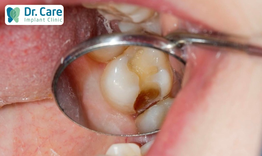 Bắt đầu từ giai đoạn 2, sâu răng sẽ gây đau nhức, khó chịu