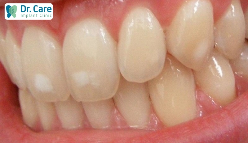 Sâu răng giai đoạn đầu thường không gây đau nhức răng