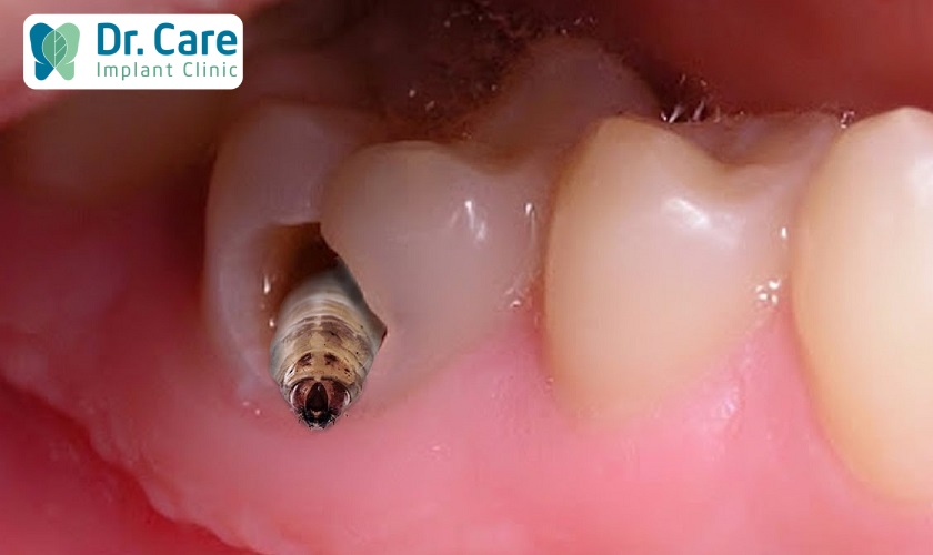 Cách giải quyết sâu răng nặng là trồng Implant Pháp
