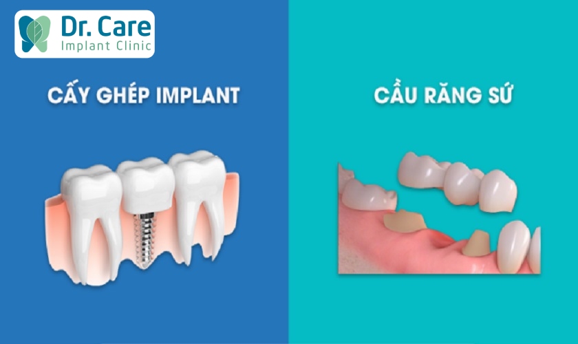 Cầu răng sứ và trồng răng Implant đều giúp phục hồi răng hiệu quả