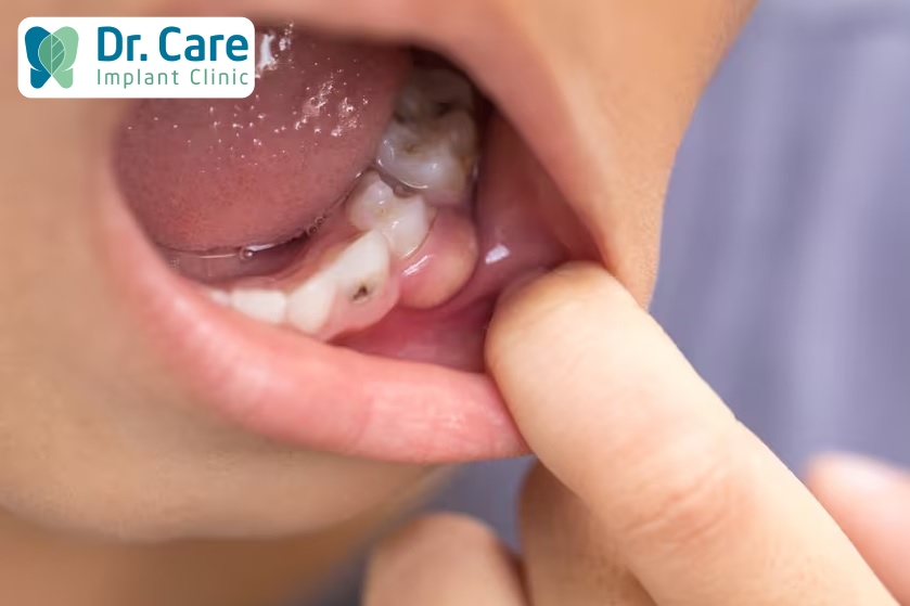 Sâu răng nếu không điều trị kịp thời sẽ dẫn đến viêm nướu
