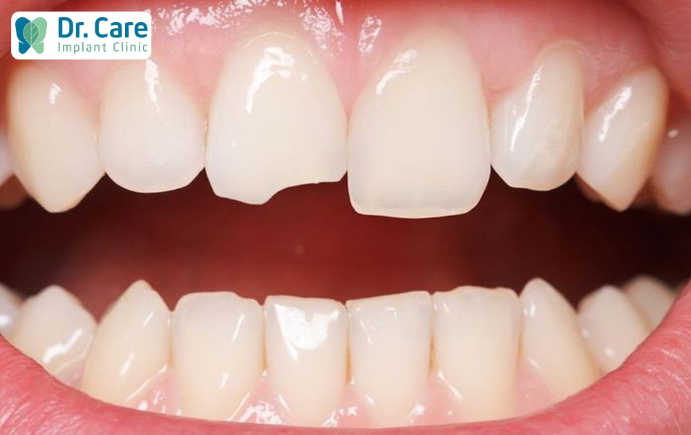 Răng bọc sứ bị mẻ cần sớm thay mão mới