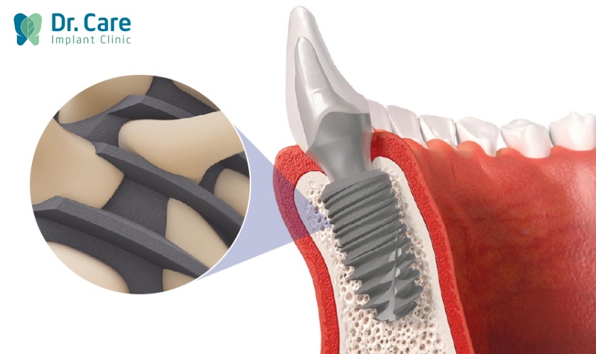 Trồng răng Implant vẫn thoải mái chơi thể thao