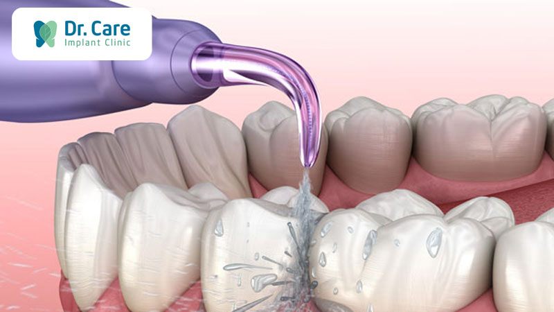 Vệ sinh răng Implant đúng cách bằng tăm nước