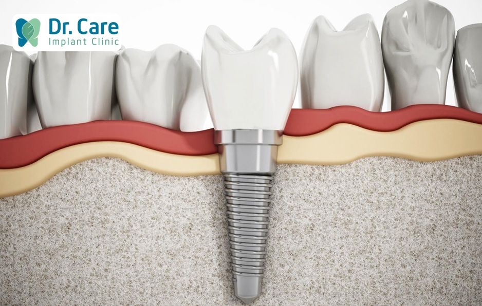 Cần điều trị viêm nha chu khỏi hoàn toàn trước khi trồng răng Implant Pháp
