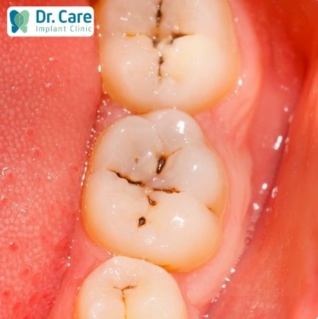Xuất hiện các đốm đen trên bề mặt là dấu hiệu của sâu răng 